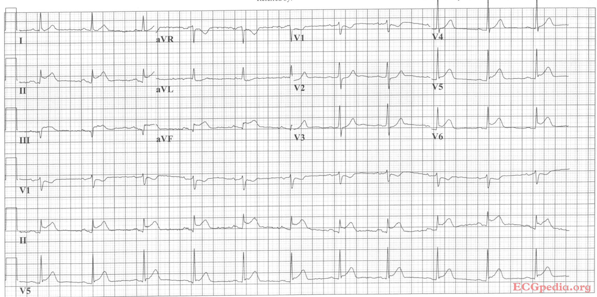 Anterior STEMI