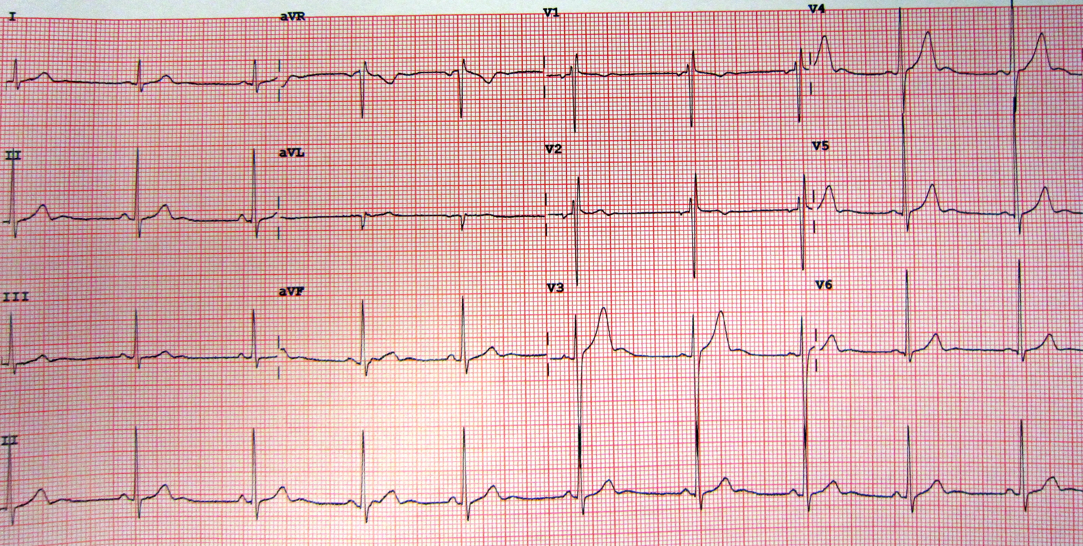 Early repolarisering