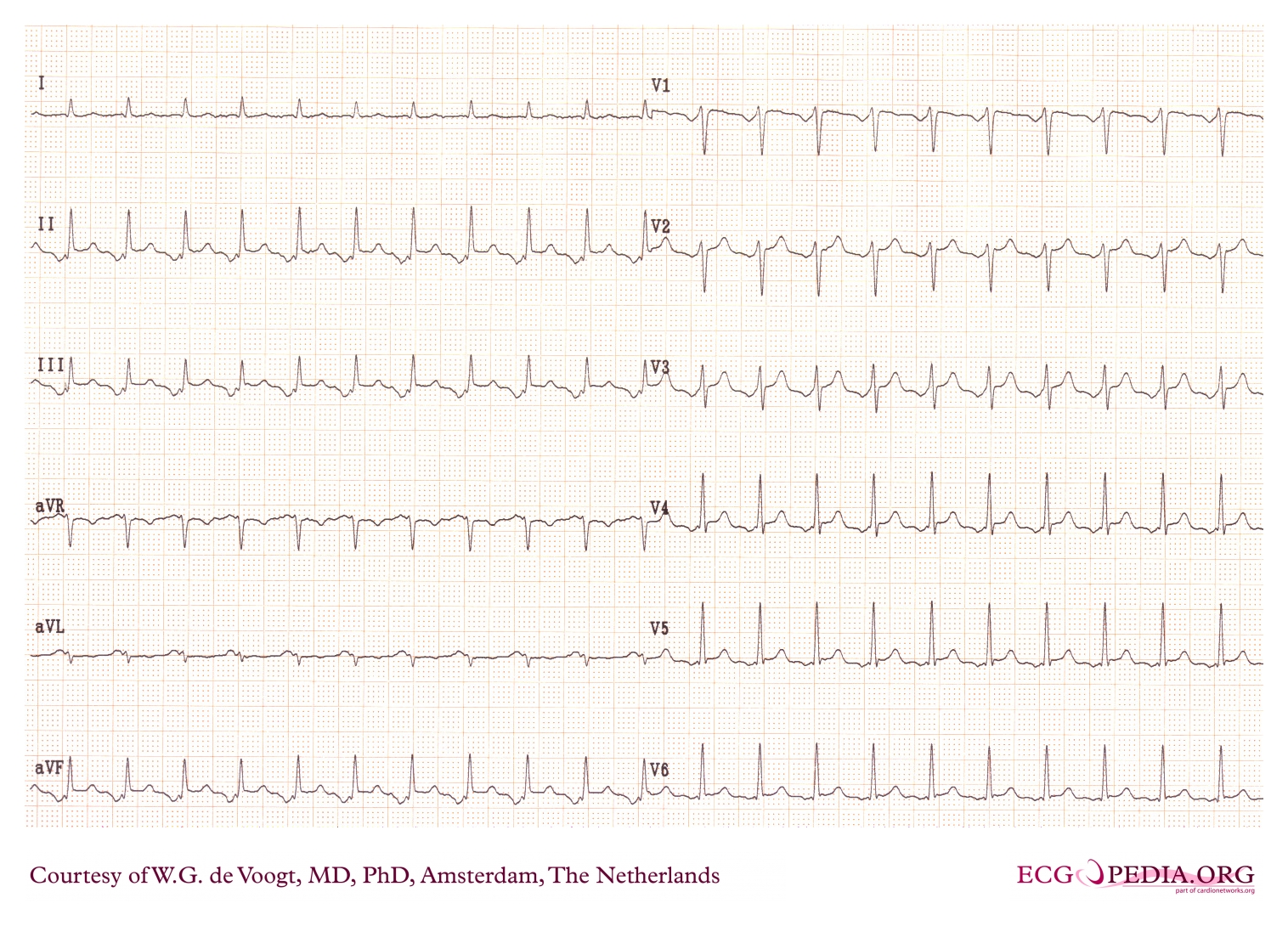 Ectopisk atriel takykardi