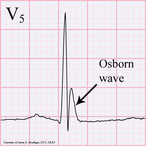 Hypotermi EKG