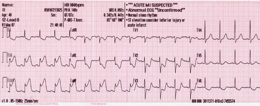Inferior STEMI