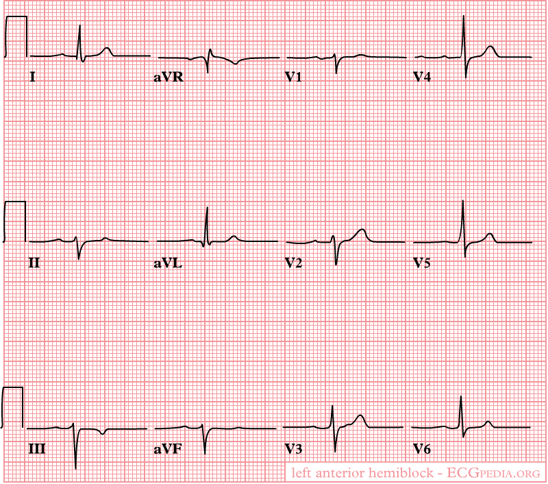 Venstre anterior fascikelblok