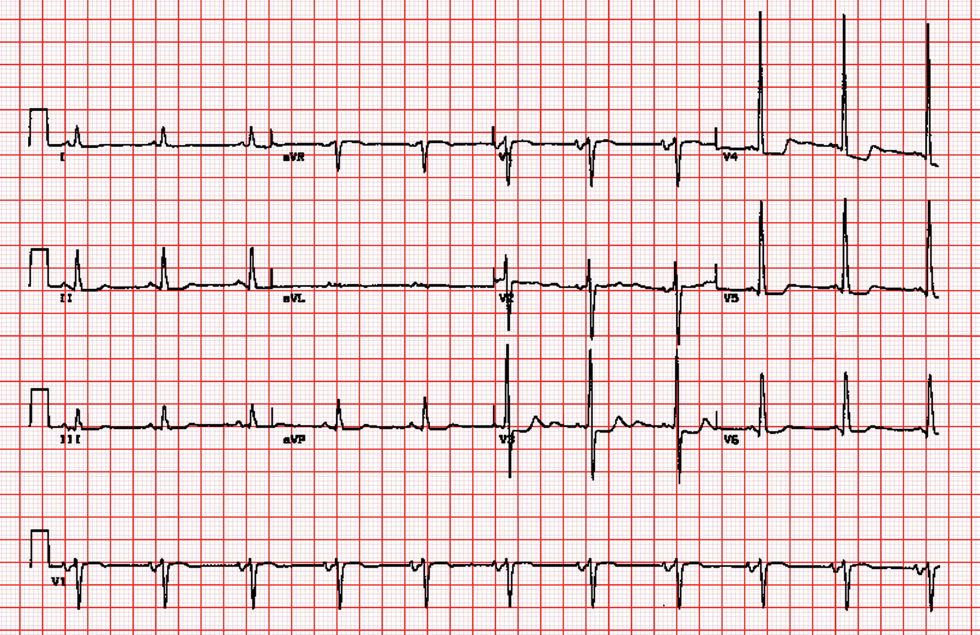 Venstre ventrikelhypertrofi
