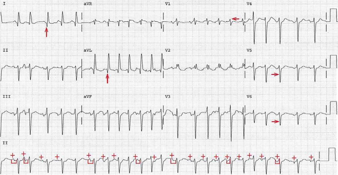 Multifokal atriel takykardia (MAT)