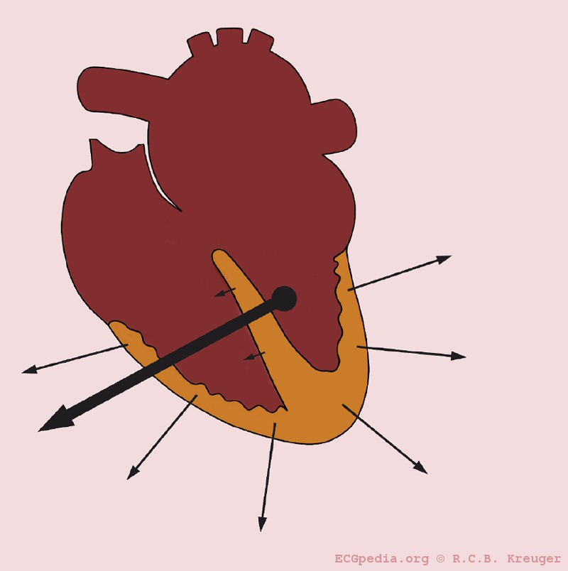 Højre aksedeviation