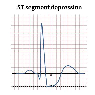 ST depression