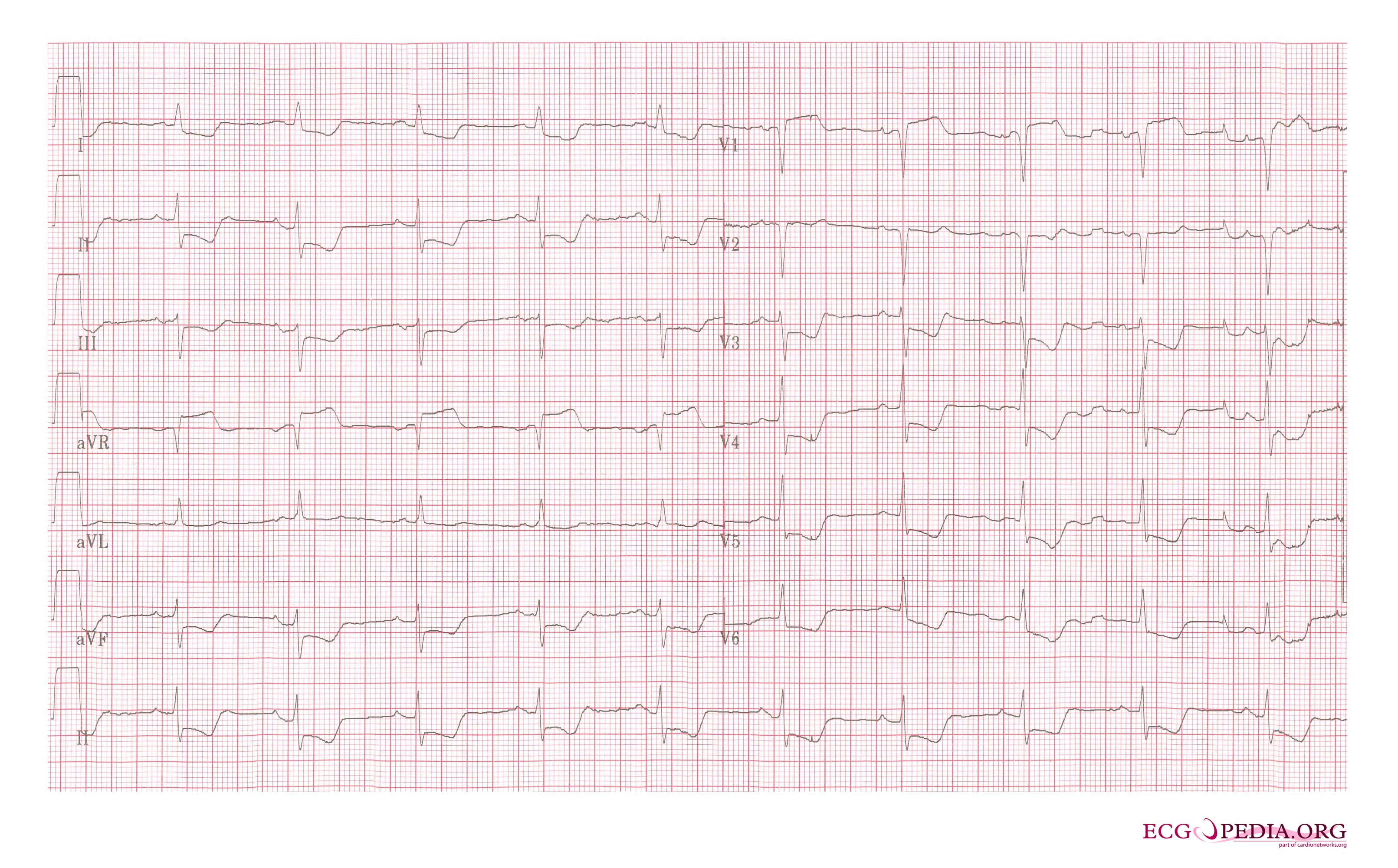 Subendokardiel iskæmi