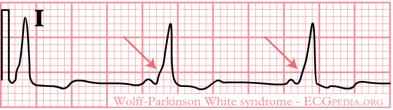 WPW syndrom med delta-bølge
